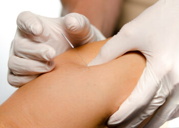 หยุดความปวดจากออฟฟิศซินโดรม ด้วยการฝังเข็ม Dry Needling