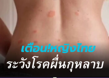 เตือน ‘โรคผื่นกุหลาบ’ พบบ่อยช่วงฤดูฝน มักเกิดกับผู้หญิง ผู้ป่วยตั้งครรภ์ระวังเสี่ยงแท้งได้